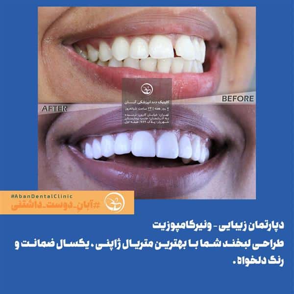 همه چیز درباره‌ی لبخند هالیوودی