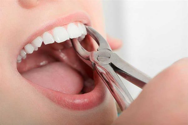 چرا کشیدن دندان آنقدرها هم که فکر می کنید بد نیست…