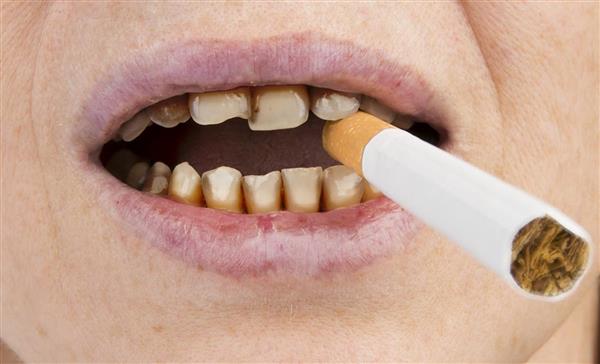 سیگار کشیدن علائم سرطان دهان