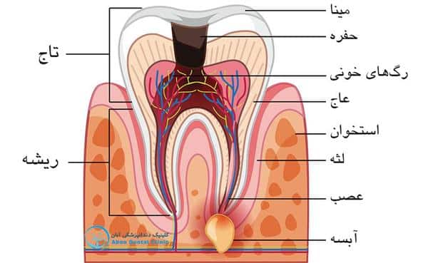 همه چیز در مورد آبسه‌ی دندانی